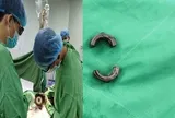 Bác sĩ tại Cần Thơ dùng máy cắt cứu người đàn ông ở An Giang gặp nạn vì “nâng cấp dương vật"