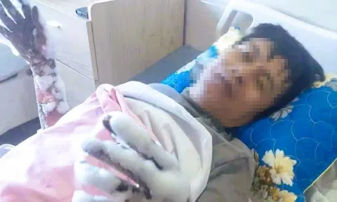 Thanh Hóa thông tin vụ nam công nhân bị điện phóng bỏng nặng 2 tay