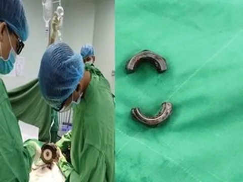 Bác sĩ tại Cần Thơ dùng máy cắt cứu người đàn ông ở An Giang gặp nạn vì “nâng cấp dương vật"